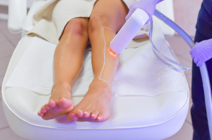 Laser Hair Removal