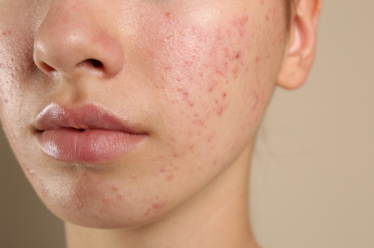 Pimples Treatment