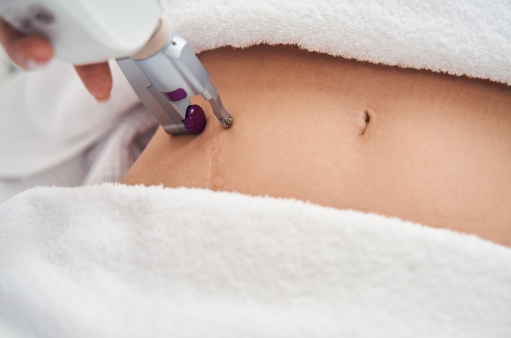Scars Treatment