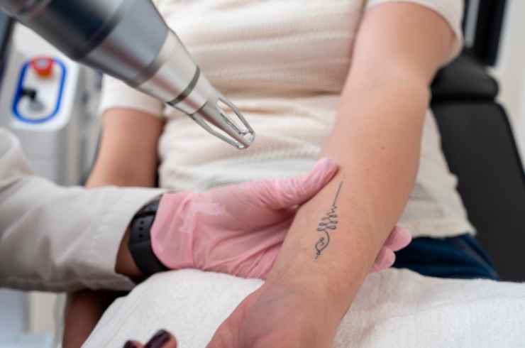 Tattoo Removal