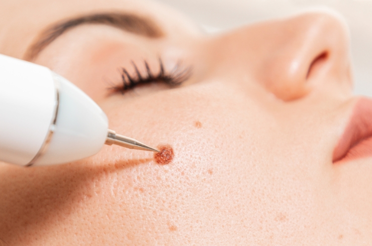 Warts Removal & Moles Removal
